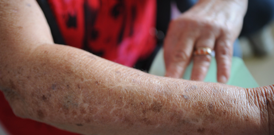 Saúde e Prevenção discute câncer de pele