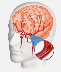 O AVC isquêmico é formado por uma interrupção no fluxo de sangue, em alguma região do cérebro, ocasionado por um coágulo (Foto: Reprodução/ Internet) 