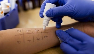 Os testes de alergia mais comuns são os que colocam algumas gotas das substâncias no antebraço do paciente (Foto: Reprodução/Internet)
