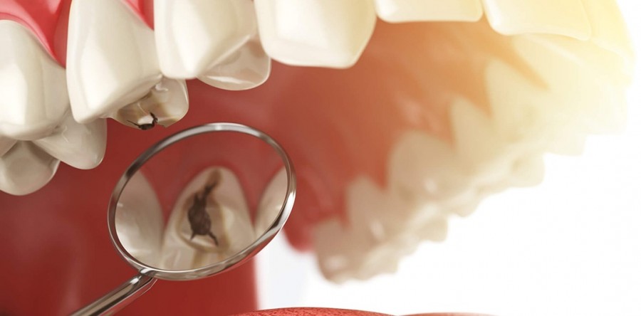 Prejuízos que amálgama causa à saúde bucal