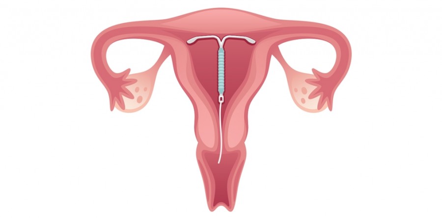 PLs querem impedir consentimento de marido para DIU
