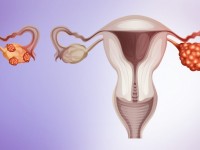 A endometriose pode afetar vários órgãos,  como  o útero,  ovários   bexiga e reto (Foto: Reprodução/Internet)