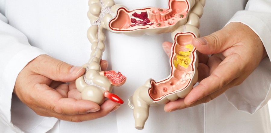 Câncer de cólon intestinal: conheça os fatores de risco