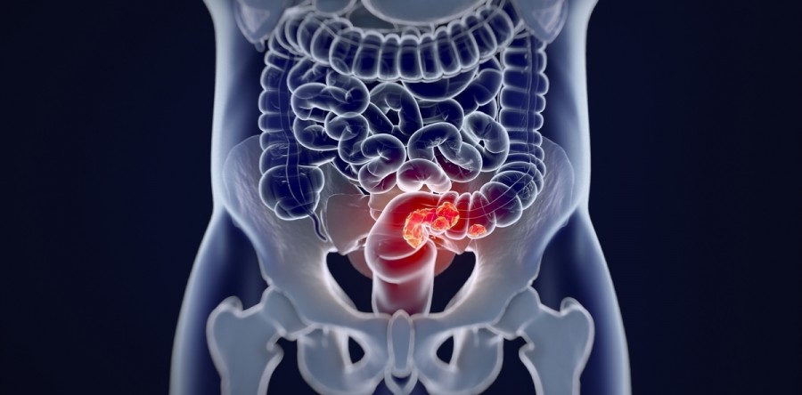Brasil bate recorde de internações por câncer colorretal
